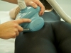 Cellulite Therapie