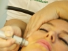 Mikrodermabrasion